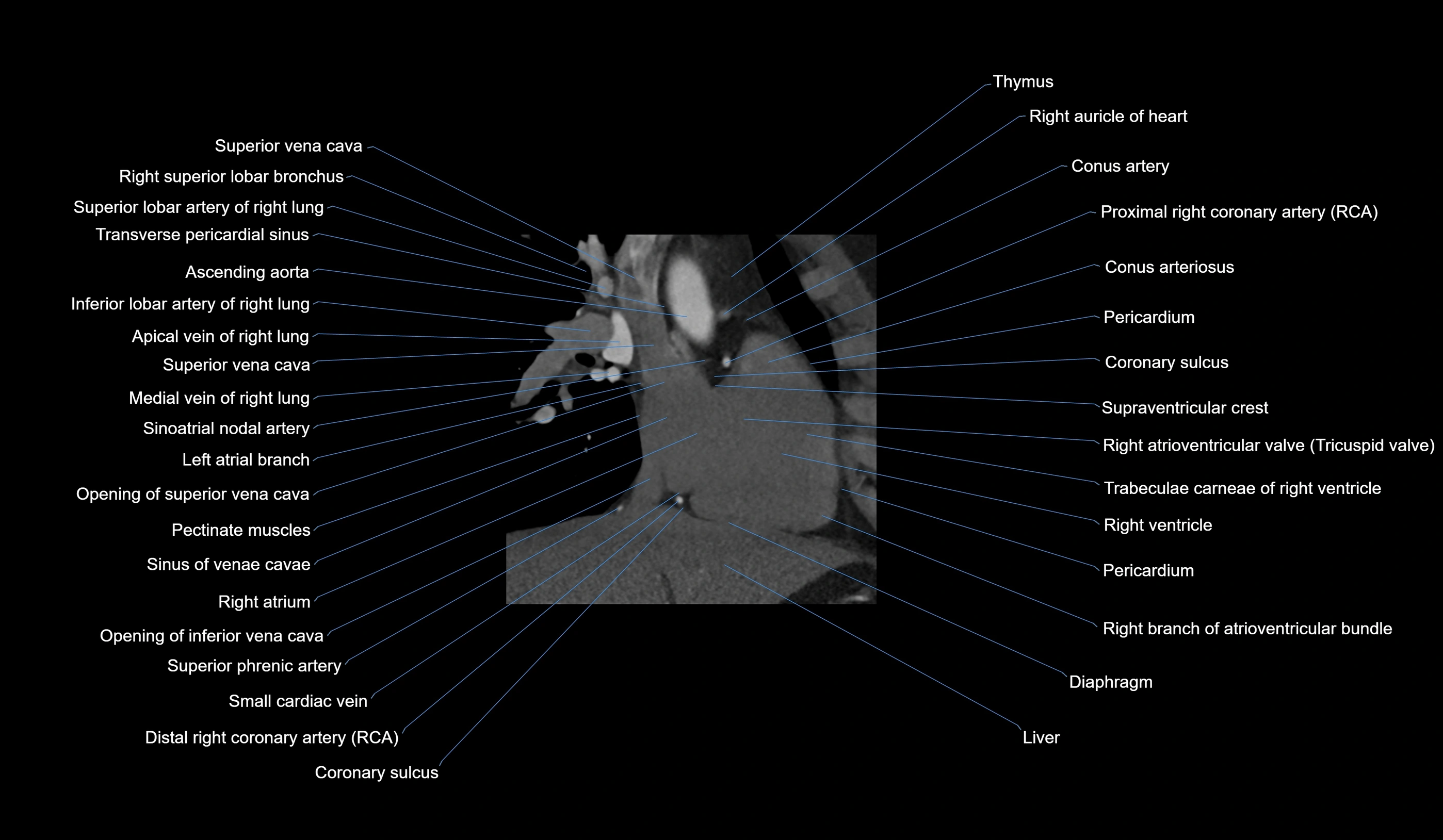 CT heart (coronary angiogram) 2 chamber view cross sectional anatomy labelled radiology image-00030.webp